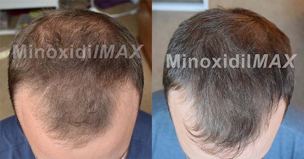 15% minoxidil results