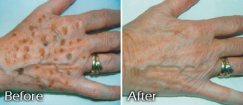 age spot microneedline