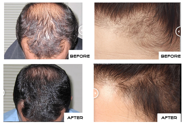 regrowmd before and after result photos