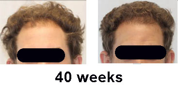 capillus before and after