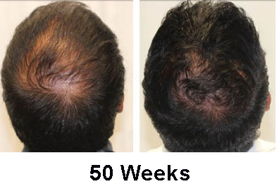 capillus real user results