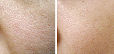 microneedling large pores