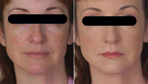 microneedling rosacea
