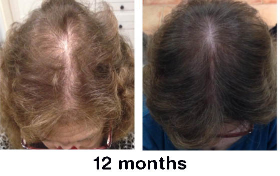 irestore before and after results
