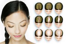 minoxidil women